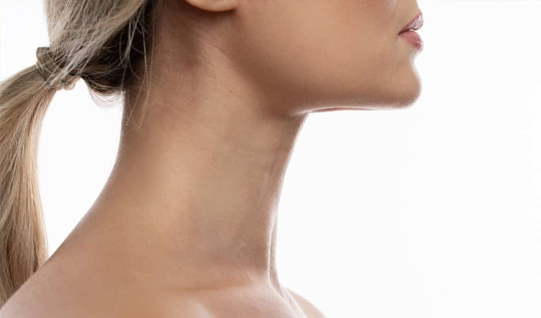Which Type of Neck Lift Is Best?