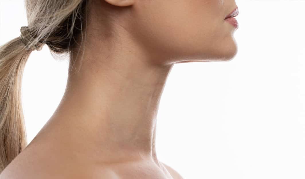 Neck Lift Options