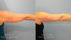 Brachioplasty before and after