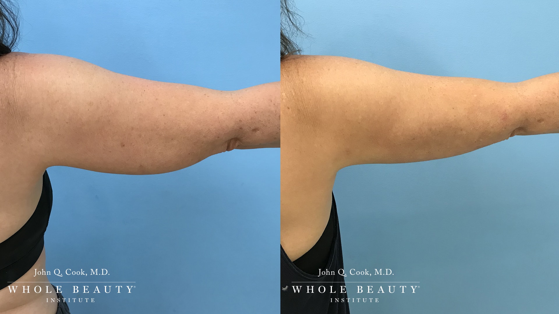 Brachioplasty before and after