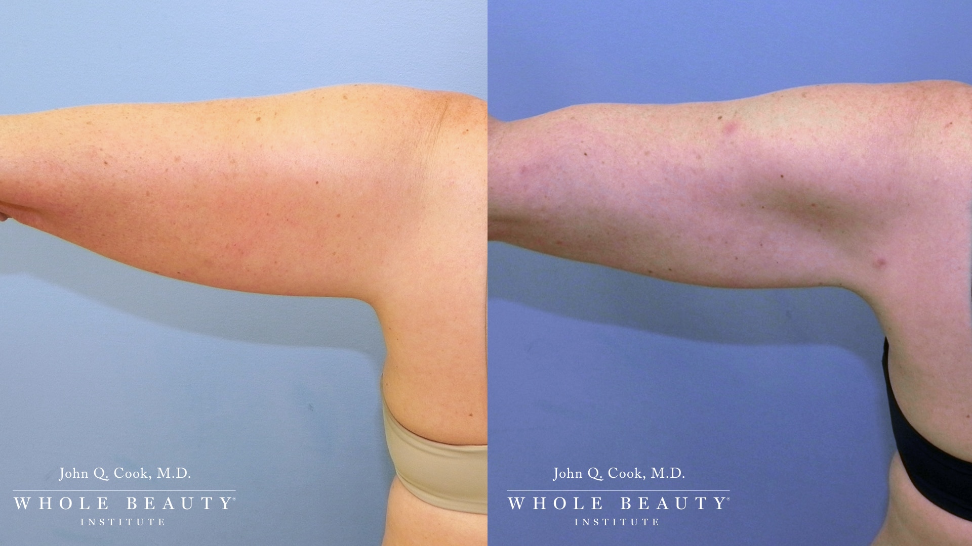 Brachioplasty before and after