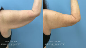 Brachioplasty before and after