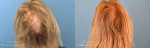 Hair Restoration before and after