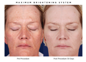 Brightening peel before and after