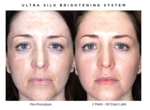 Ultra Silk peel before and after