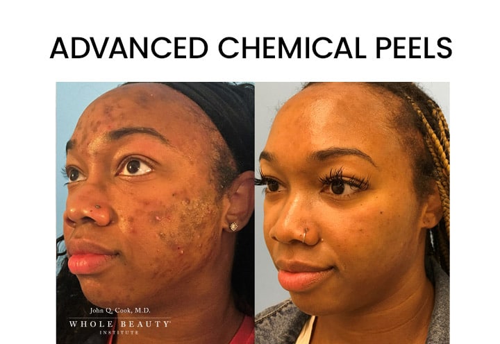 advanced chemical peels