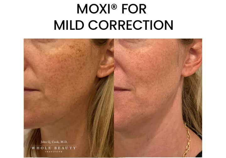 MOXI for Mild Correction
