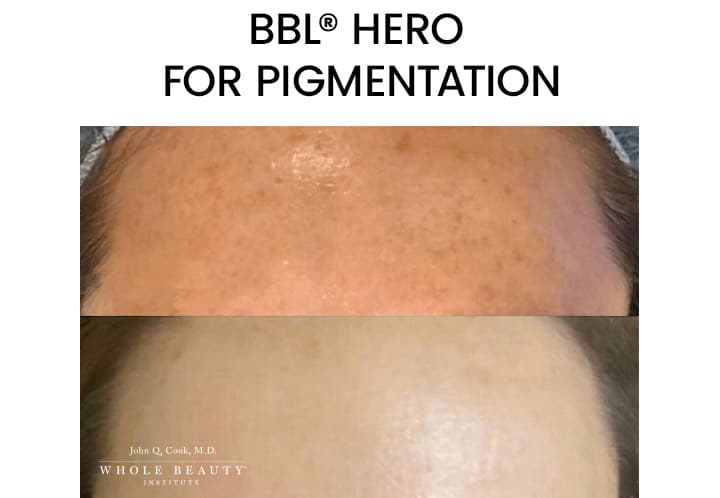 BBL Hero for Pigmentation