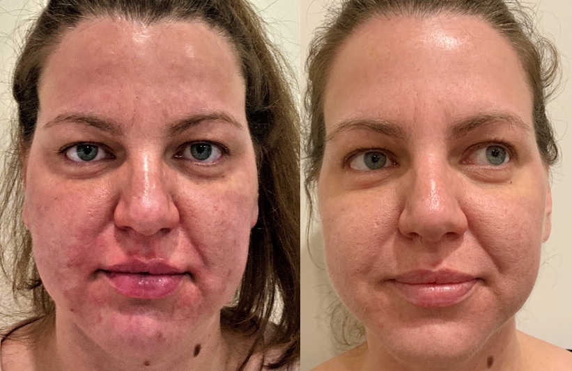 Before and after PRX-T33 combined with Moxi and PRP