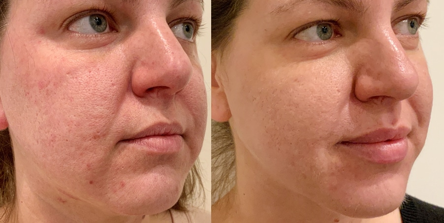 Before and after PRX-T33 combined with Moxi and PRP
