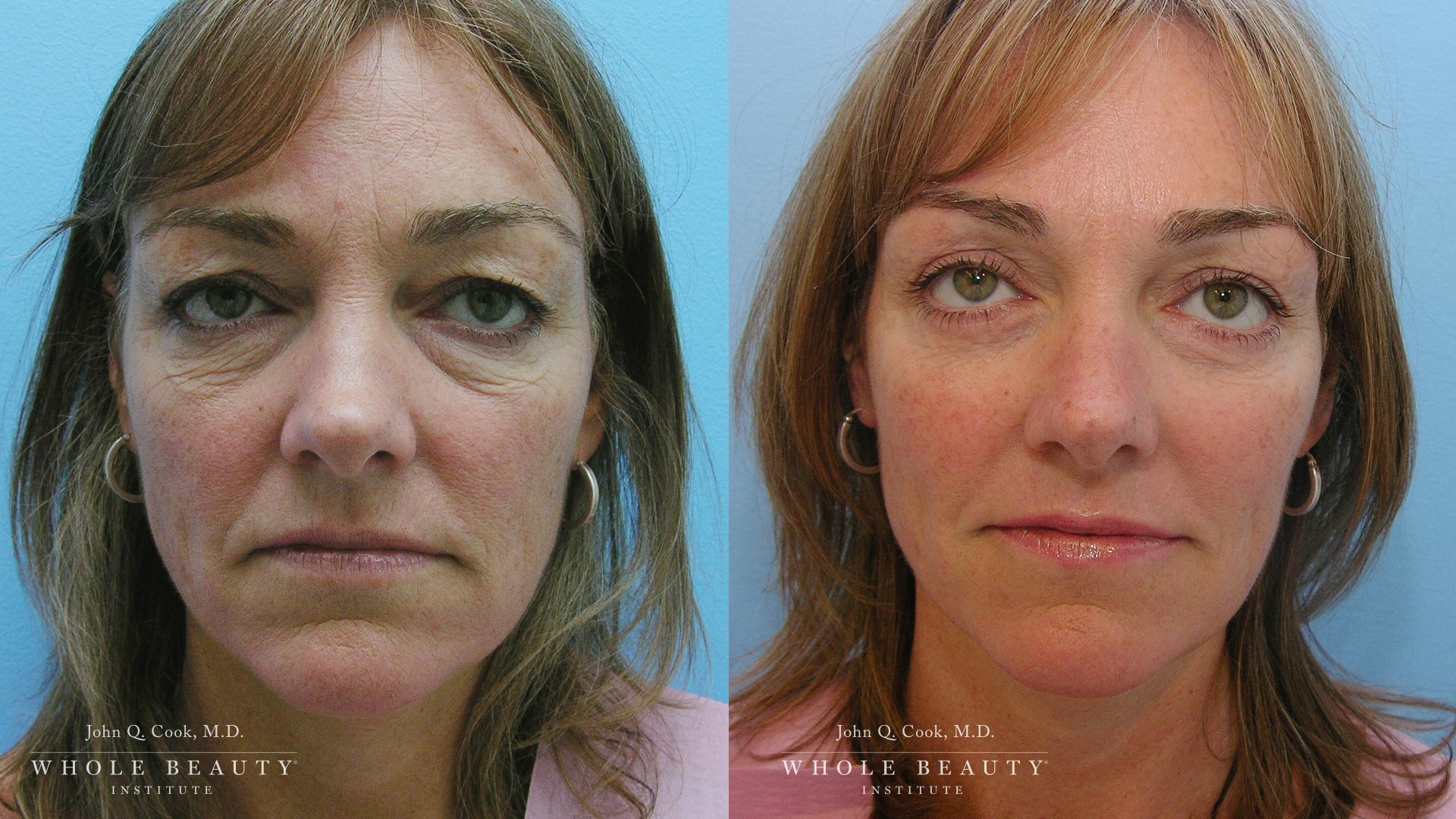 Blepharoplasty before and after