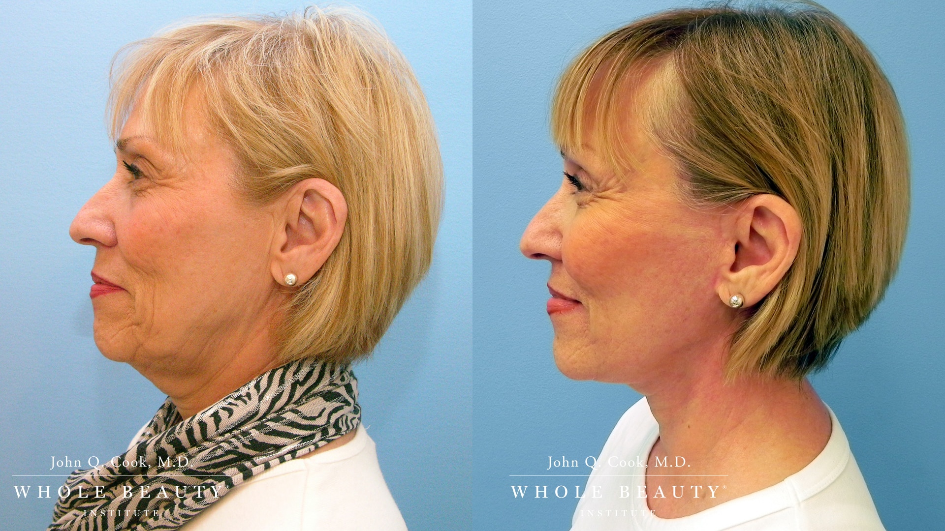 facelift before and after