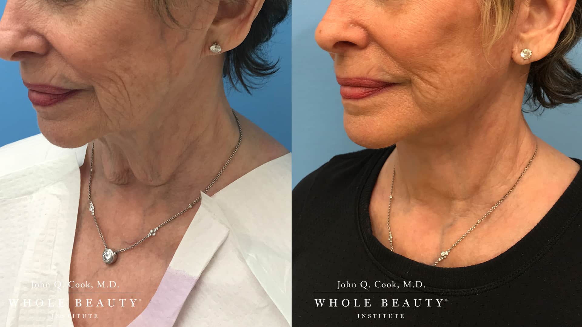 facelift before and after