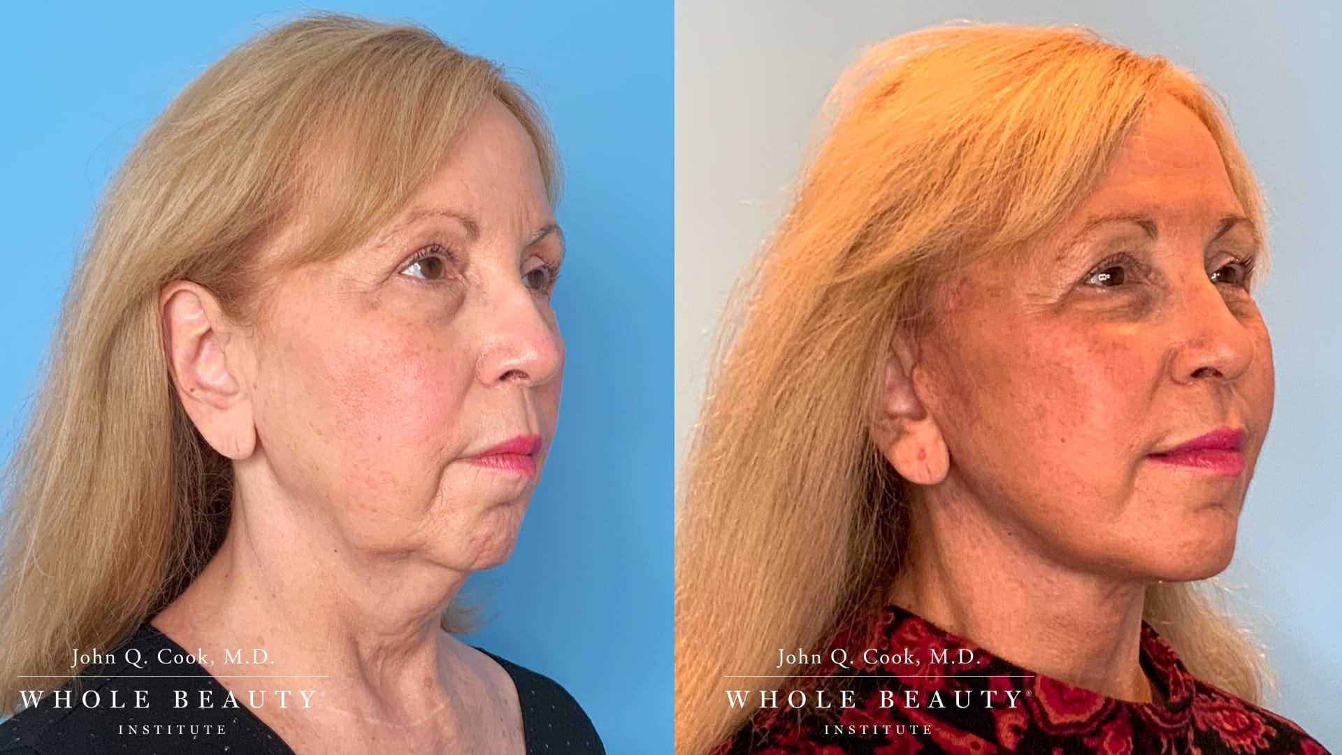 facelift before and after