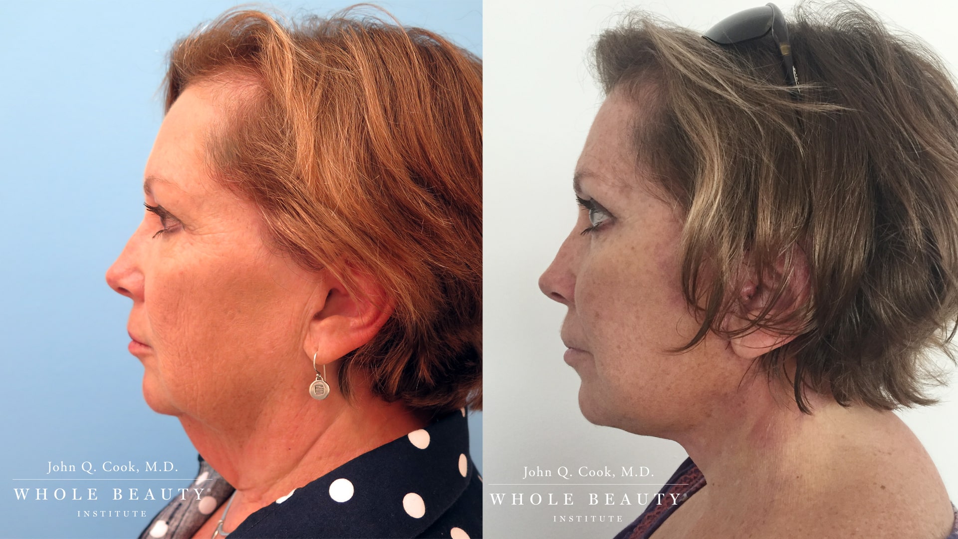 facelift before and after