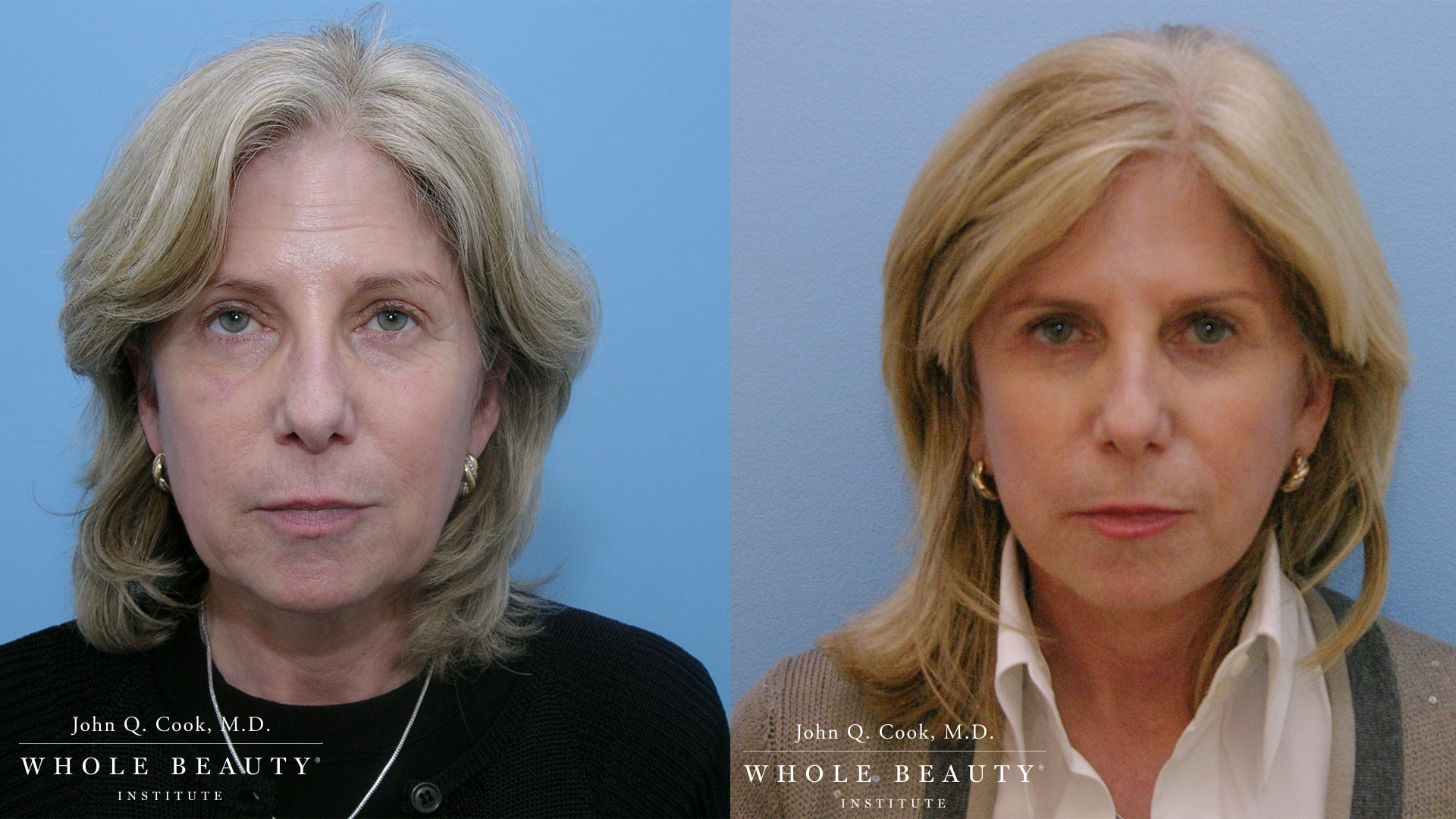 facelift before and after