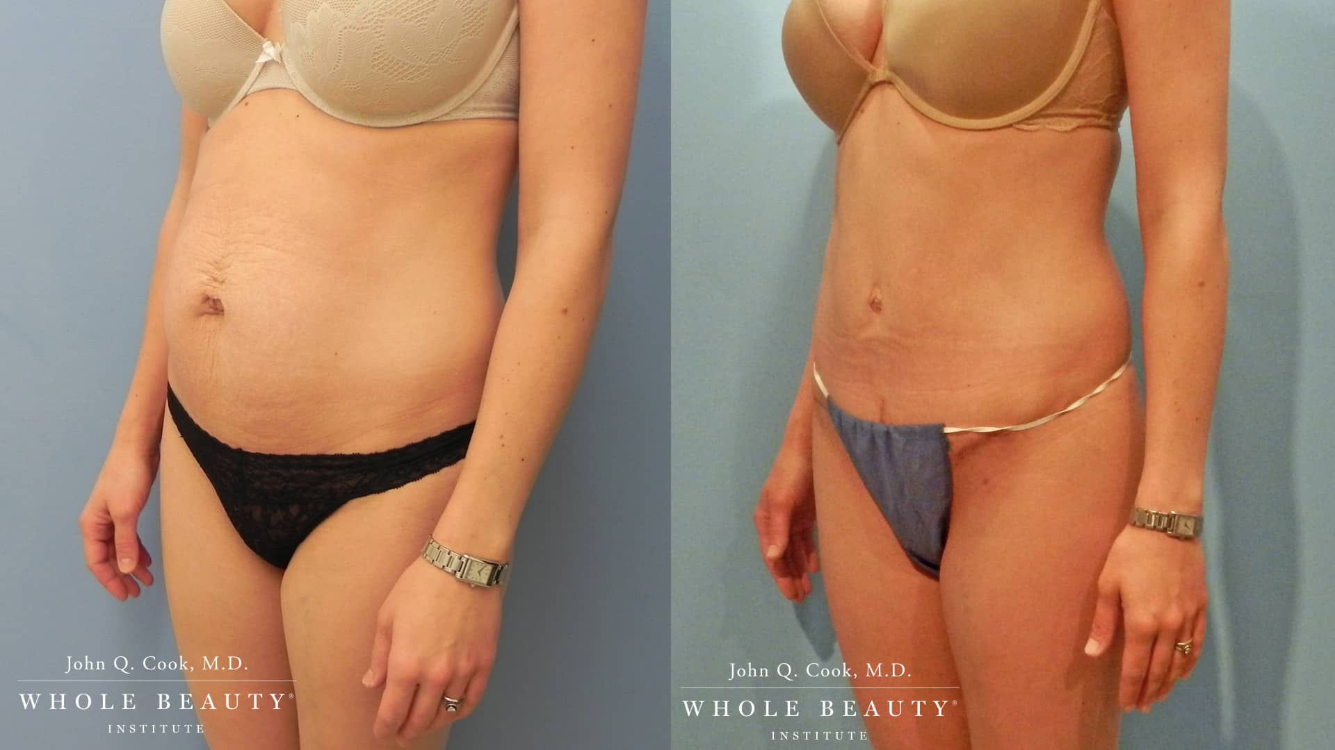 Tummy Tuck before and after