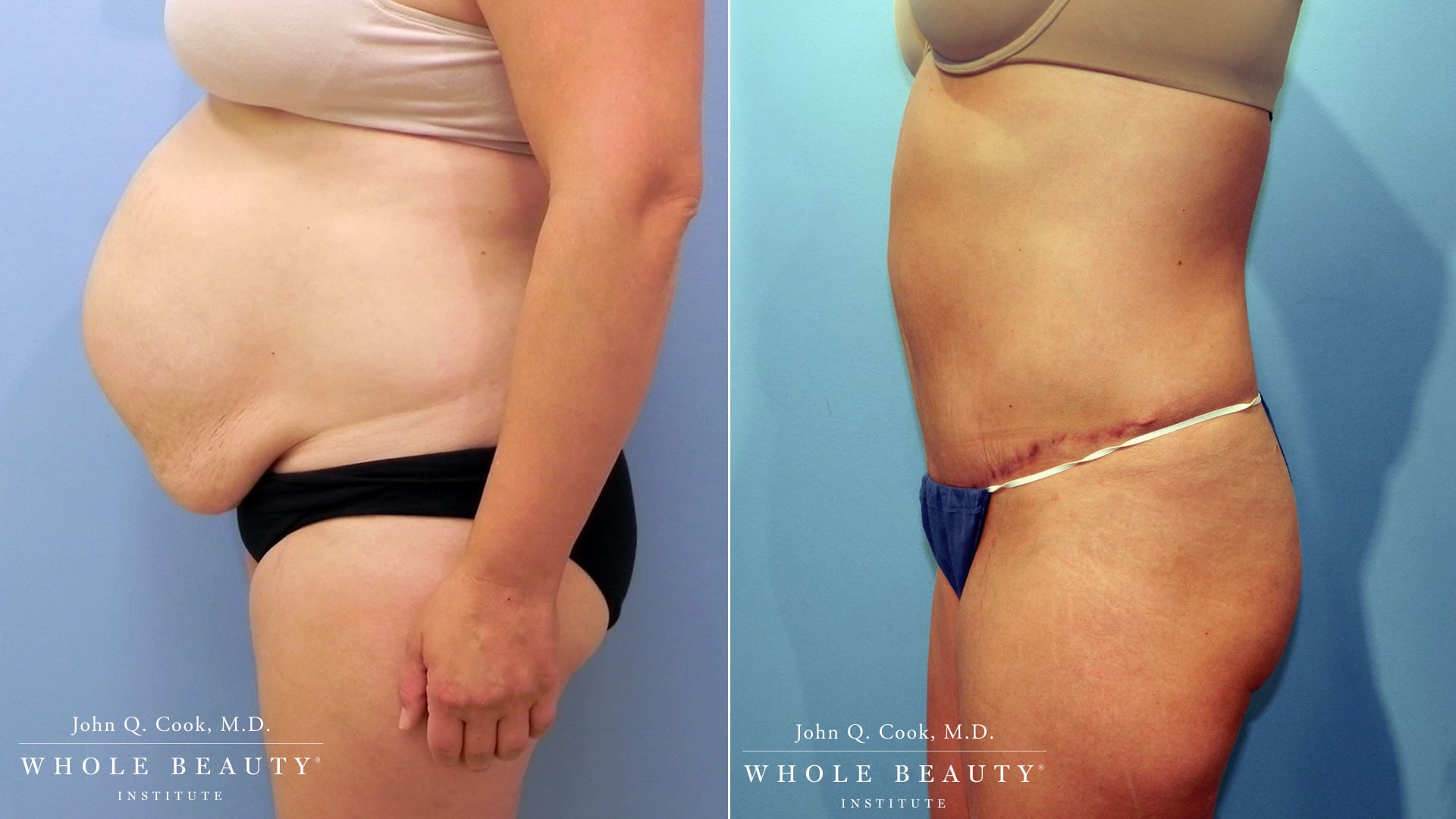 Tummy Tuck before and after