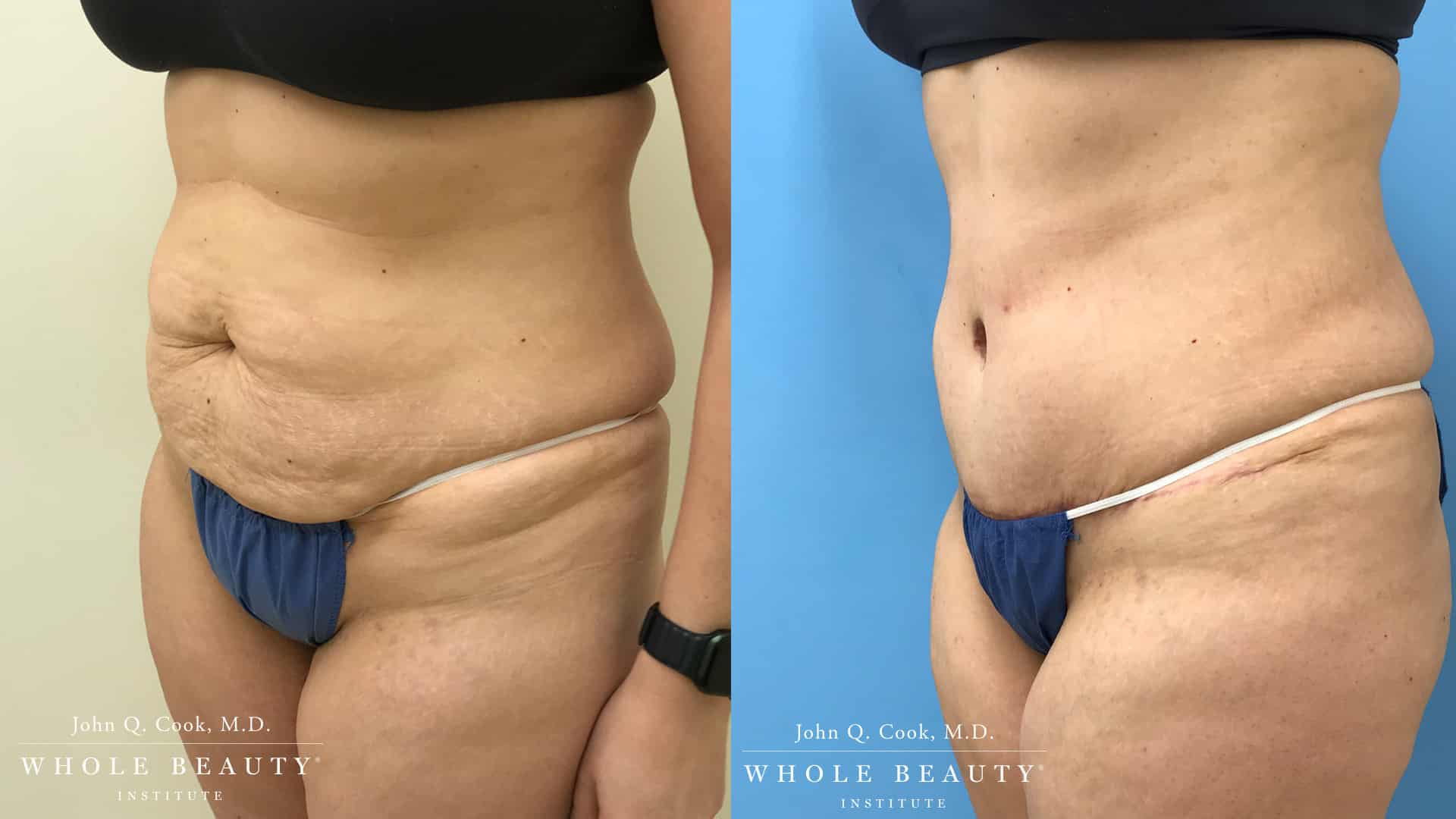Tummy Tuck before and after