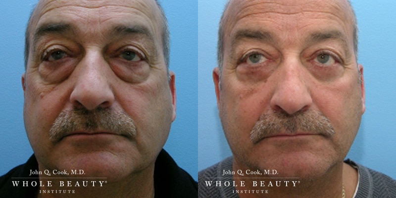 blepharoplasty before and after