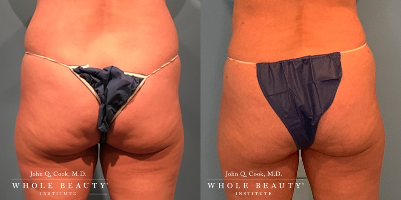 BodyTite before and after