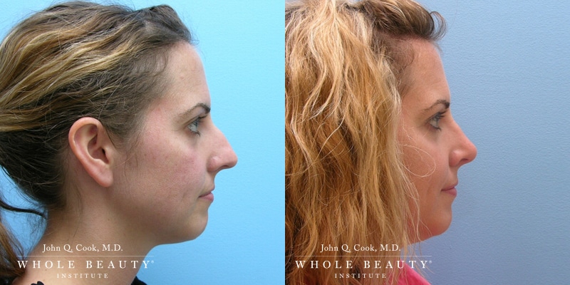 Rhinoplasty before and after