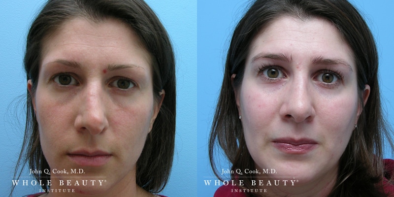 Rhinoplasty before andafter