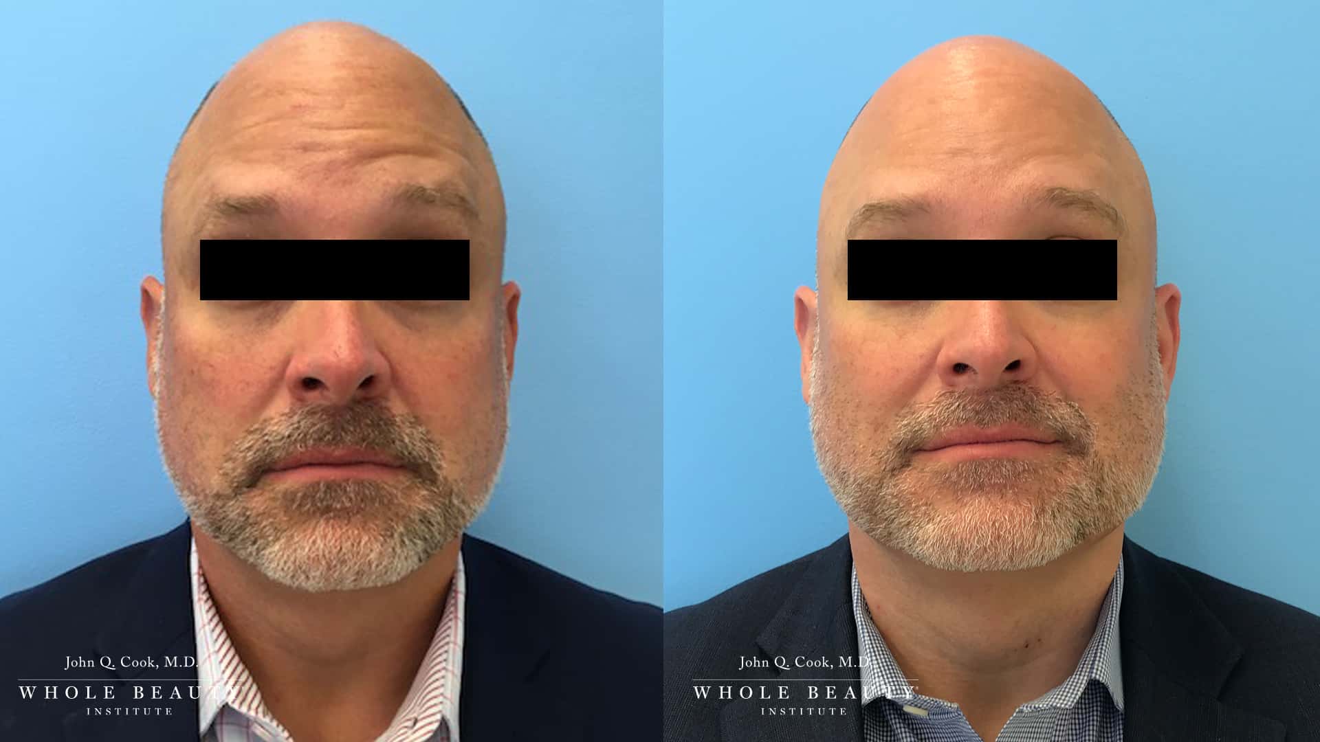 botox for men | forehead lines