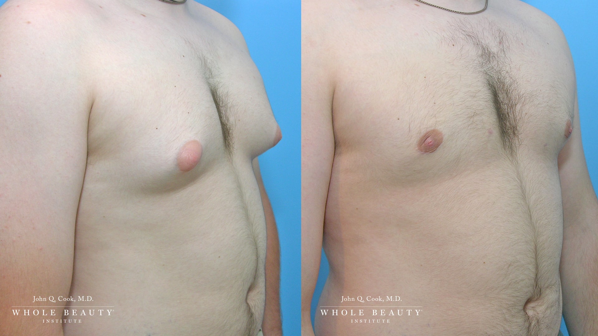 gynecomastia before and after