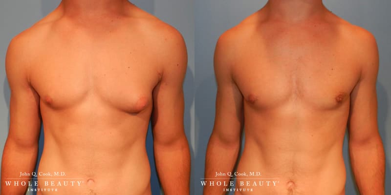 gynecomastia before and after