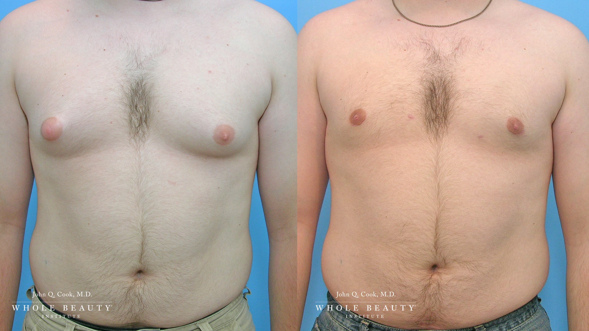 gynecomastia before and after