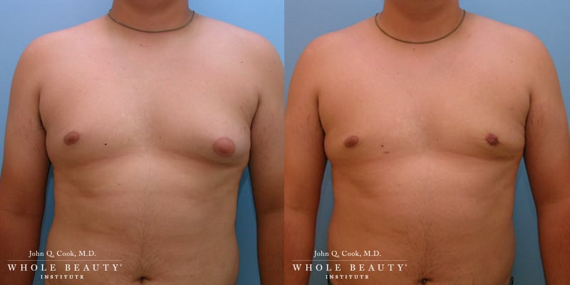 gynecomastia before and after