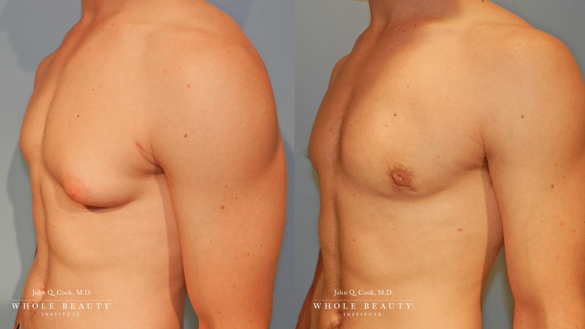 gynecomastia before and after