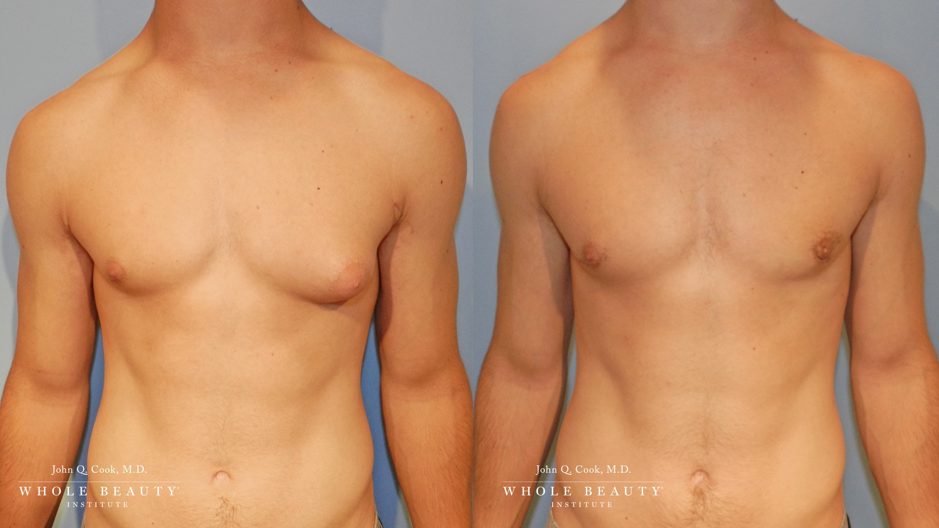 gynecomastia before and after