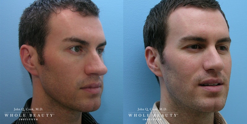 rhinoplasty before and after