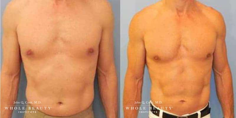 slimlipo for men