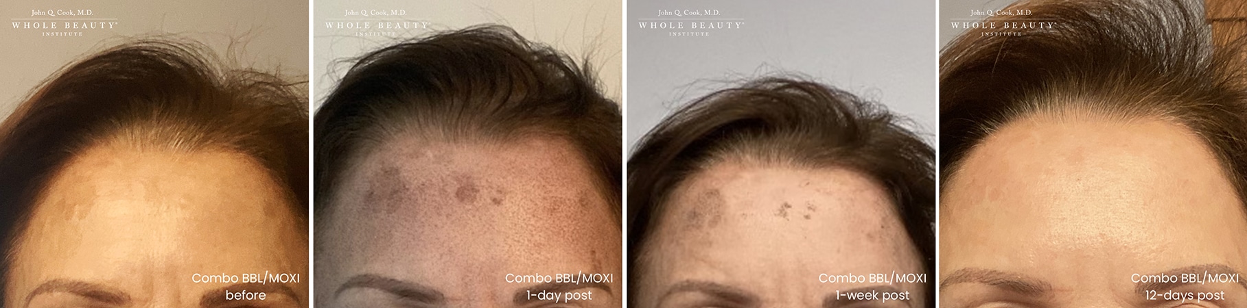 Moxi and BBL combo treatment