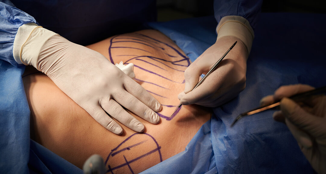 Why Should Dr. John Q. Cook Be Your Choice for a Tummy Tuck Surgeon?