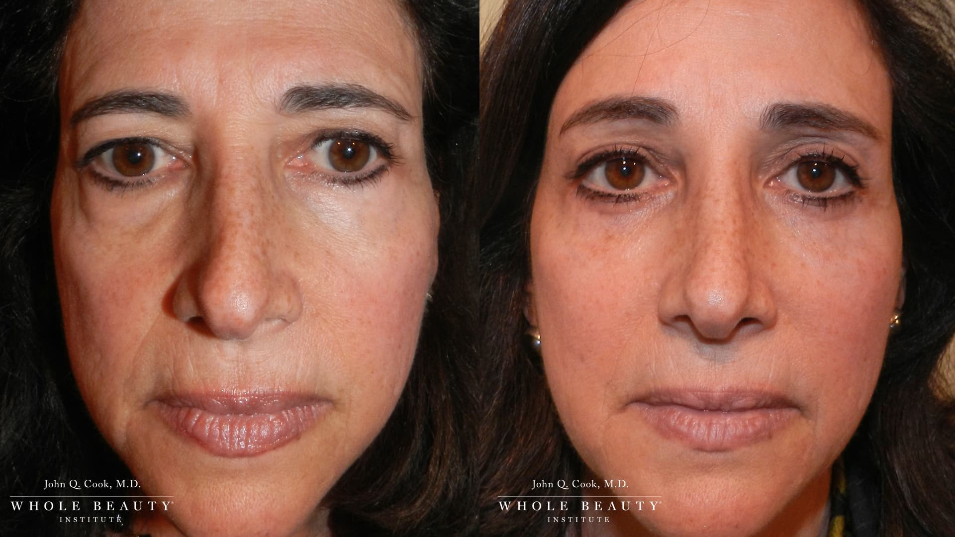 rhinoplasty before and after