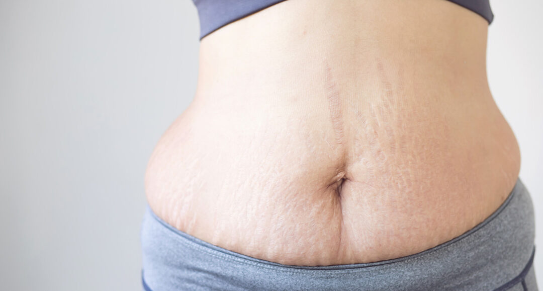 Mommy Makeover Myths: What’s Fact and What’s Fiction?