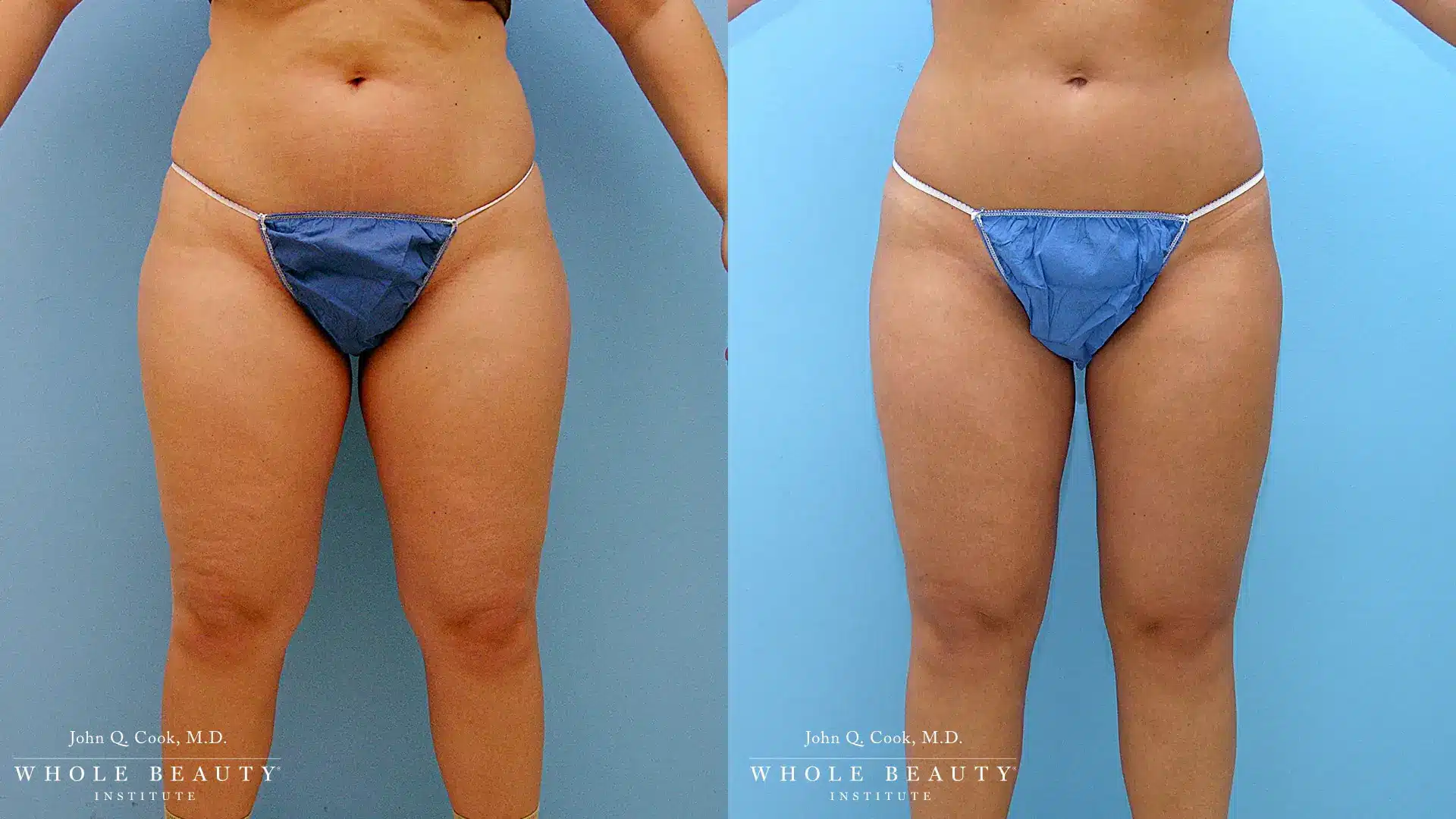 Whole Beauty® Institute | Liposuction