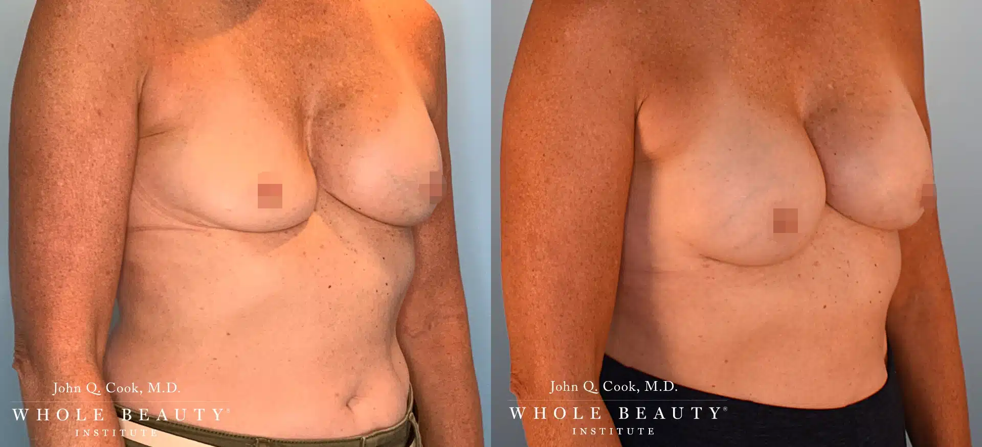 Implant Replacement and Structural Lift | Dr. John Q. Cook