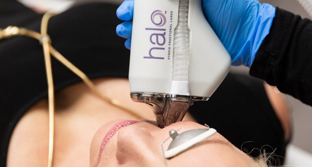 What Is the HALO® Fractional Laser Good For?