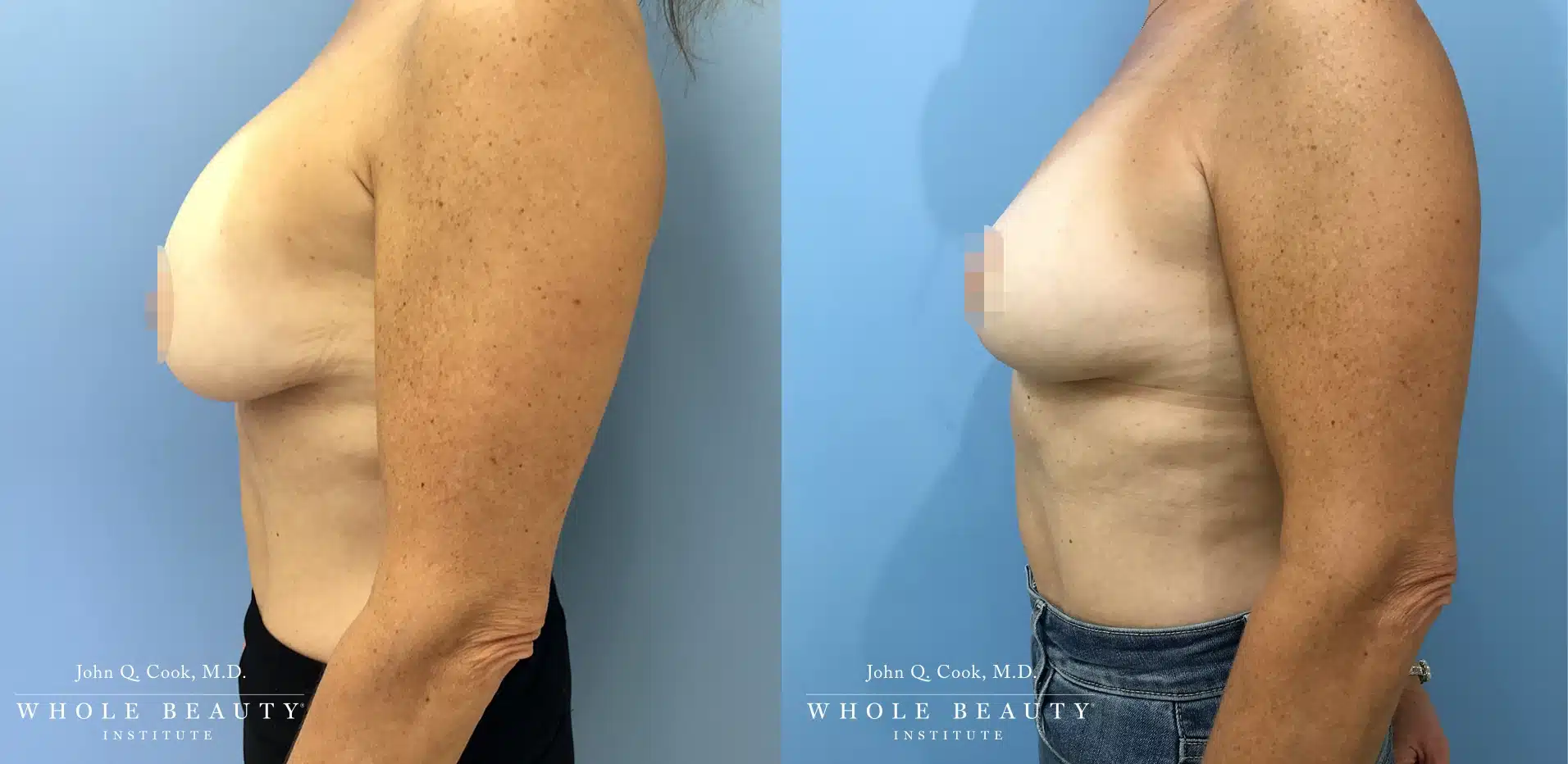 Implant Removal and Structural Lift | Dr. John Q. Cook