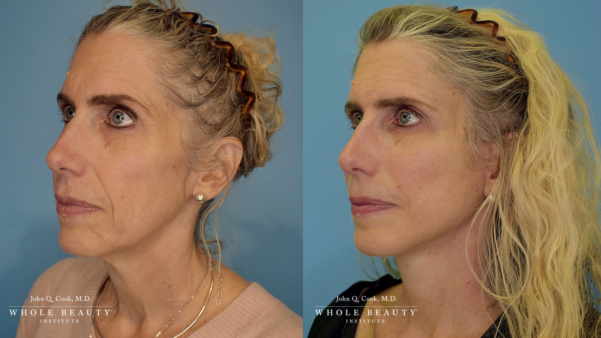 Side-by-side portrait of a woman before (left) and after (right) cosmetic treatment, with a blue studio background.