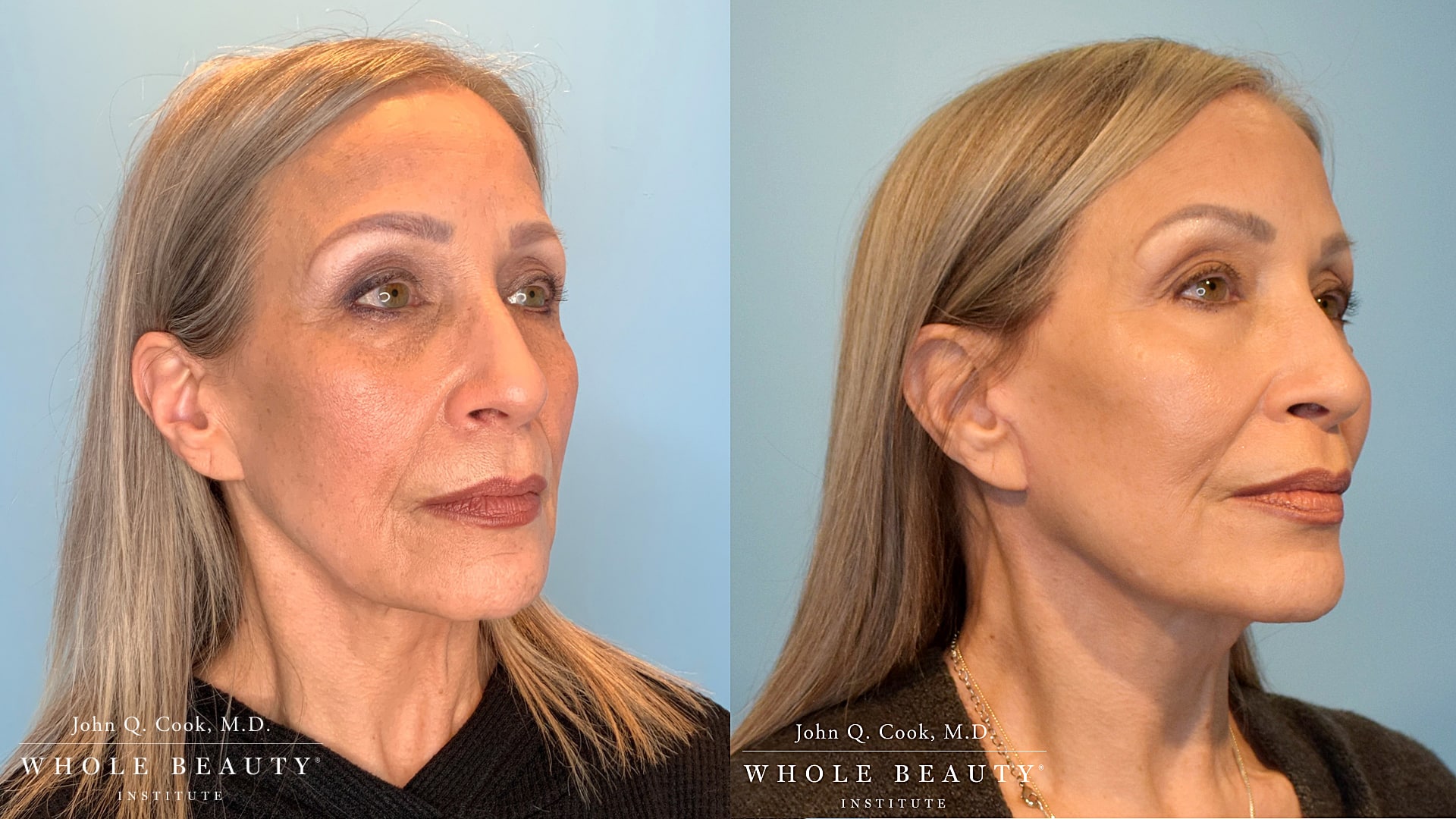 Before-and-after portrait showing a woman’s facial rejuvenation results; left image: earlier skin with fine lines, right image: smoother, lifted look after treatment. Branding text visible: John Q. Cook, M.D./Whole Beauty Institute.