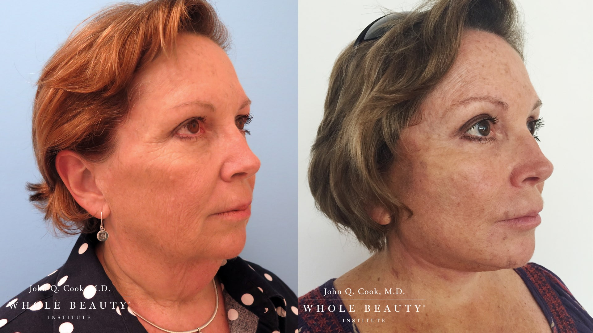 Side-by-side before (left) and after (right) photos of a woman, showing facial rejuvenation with smoother skin and fewer wrinkles.